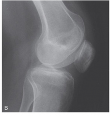 Patella baja is a known problem commonly encountered intraoperatively when converting which of the following patients to a total knee arthroplasty.  1-Previous medial compartment unicompartmental arthroplasty; 2-Previous medial proximal tibial ope...