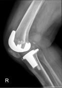 Patella baja is often encountered during conversion from a proximal tibial osteotomy to a total knee arthroplasty. The most likely cause of patella baja when converting a previous medial proximal tibial osteotomy to total knee arthroplasty is scar...