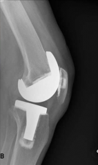 Hx: 70yo F has persistent anterior knee pain and stiffness 10 mths s/pTKA w/associated lateral patellar release. xrays before and p/ surgery Fig A & B.  Pre-op, her Insall-Savati ratio = 0.95, compared to 0.76 post-op. Which of the following is th...