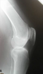 iatrogenic patella baja and an elevated joint line caused by excessive resection of the distal femur and contracture of the patellar tendon likely as a result of lateral patellar release. Figure A does not demonstrate pre-operative patellar baja, ...