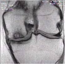 Contraindications to performing a unicompartmental/unicondylar knee arthroplasty include: inflammatory arthritis, fixed varus/valgus deformity more than 10 degrees, flexion contracture more than 10 degrees, less than 90 degrees of flexion pre-oper...