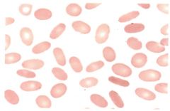 -Caused by a defect in the membrane skeleton


-Most prominent peripherial blood smear finding is an increase in malformed cells (over 25% of population)


-Membrane may fragment under circulation stress and produce RBC fragments 