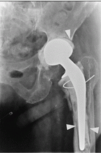Can be caused by Coagulase negative staph, S. aureus, Propionobacterium sp., Diphtheroids, or bacteremia pathogens. Diagnosis is from radiographic evidence of loosening and erosion. Aspiration of the joint will show evidence of bacteria. 