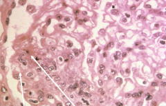 + anti-dsDNA test


global erythematous rash


< 50% glomeruli effected