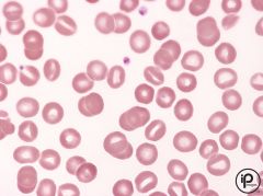 -This disorder can be seen in the genetic defect, thalassemia [abnormal hemoglobin production], lead poisoning, and alcoholic cirrhosis. 


-The blood cells contain increased sodium and decreased potassium


-The cells are overhydrated


-T...