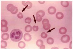 Describe the lab findings in G6PD Deficient patients. Consider G6PD levels, autohemolysis tests, and bodies that would be present on a stain. Also note what is indicated in the image that may be a clue to diagnosis. 