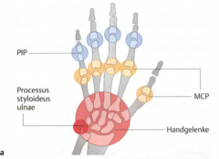- symmetrische Arthritis an den kleinen Gelenken von Händen und Füßen
- Fingergrundgelenke, seltener die Mittelgelenke und praktisch nie die Endgelenke
- Im Verlauf Beteiligung der größeren Gelenke (Sprung-, Knie-, Hüft-, Hand-, Ellenbogen- ...