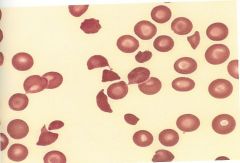 This is an example of a traumatic of microantiopathic hemolytic anemia. It's a consumptive coagulopathy that involves the deposition of microthombi in the blood cells. These deposits damage circulating red cells.