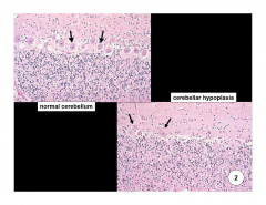 Cerebellar hypoplasia- 

Small cerebellum

Caused by a viral infection, inherited/developmental genetic defect 