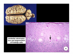Cerebellar abiotrophy- 

Premature degeneration, loss of purkinje cells and granular layers

Due to intrinsic metabolic defect 