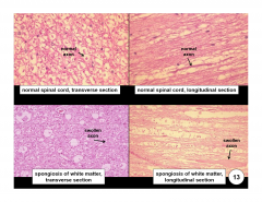 Ex. Wallerian degeneration (secondary to axon degeneration)

Fragmentation of myelin leads to vacuolization of the neuropil, whichs termed "spongiosis", or a spongy appearance to the nervous tissue 