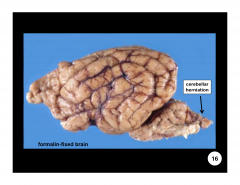 What are some of the gross lesions associated with brain edema?
