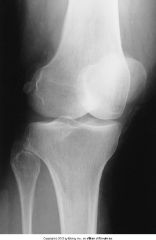 This image represents which knee projection?