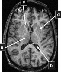 Onderstaande afbeelding toont een T1-gewogen MRI opname van de hersenen in het axiale vlak.
Welke pijl wijst naar de thalamus?
a. pijl a
b. pijl b
c. pijl c
d. pijl d
