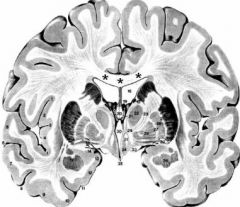 Onderstaande afbeelding toont een hersenplak.


Welke structuur is in deze hersenplak NIET (voor tenminste een gedeelte) zichtbaar?


a. derde ventrikel


b. laterale ventrikels


c. mesencephalon


d. temporaal kwab