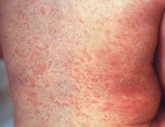 Cause: Togaviridae Rubivirus Rubella
Dx: Rubella IgM Ab

"rash spreads face to body"
S/S: coryza, low fever, joint pain, cervical lymphadenopathy
Complications: risk of encephalitis, MANY complications if Congenital Rubella Syndrome