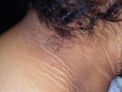 velvety hyperpigmentation
Reflects possible disease-state:

insulin-resistance (e.g. DM, PCOD), 

obesity  

Endocrine dysfunction (e.g. hypothyroidism, Cushing's, Addison's, acromegaly)