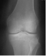 he radiographs and clinical presentation are consistent with a patient who has undergone a previous patellectomy and is now developing degenerative arthritis of the knee. Patellectomy is an indication to use a posterior stabilized implant. The PS ...