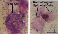 Gardnerella vaginalis = grampositive kokkoide Stäbchen

pH > 4,5, Döderlein-Stäbchen vermindert, Amin-Test: Intensivierung des Fischgeruchs bei Beträufeln mit Kalilauge

Metronidazol
