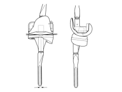 Figure A demonstrates a total knee prosthesis design. Which of the following motions is constrained in this particular design: 1-Complete anterior-posterior translation constraint only 
2-Partial varus-valgus angulation constraint only 
3-Partia...
