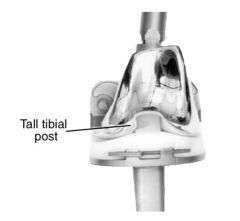 A 64-year-old female with rheumatoid arthritis is undergoing a left total knee arthroplasty. During the tibial cut, a ligament is transected by a reciprocating saw. The ligament is not able to be repaired. The surgeon is balancing the tibial and f...
