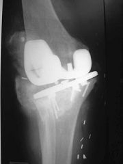 The history, examination, and image is consistent with an iatrogenic MCL injury that is irreparable. An unlinked constrained (varus-valgus constrained) prosthesis has a tall tibial post and a deep femoral box, which provide more inherent coronal p...