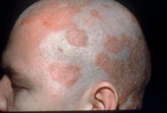 Red, splotches esp. on scalp
Cradle cap
Cause: Malassesia/Pityrosporum ovale
Treat: sunlight -> antifungals/dandruff shampoos