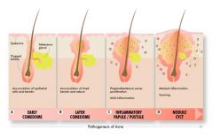 Propionibacterium acnes
Treat: clean, dry, benzoyl peroxides (OTC)
Severe: Vit A (retinoic acid) - birth defects - check for pregnancy and prescribe contraceptive 