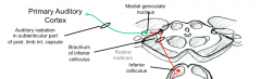 posterior limb of internal capsule (sublenticular)