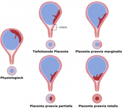 KL: plötzliche, schmerzlose Blutungen im 3. Trimenon oder während der Geburt (vor dem Blasensprung)

Vorgehen: P.p. marginalis/partialis bei gutem CTG vaginale Entbindung möglich, P.p. totalis Sectio