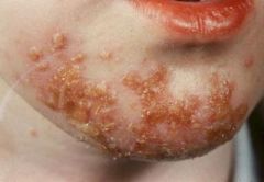 red/yellow, crusty sores near nose & mouth
"honey colored crusted lesions"
"fluid filled vesicles" - R/O herpes & varicella
Cause: S. aureus/pyogenes
Treat: Abx (topical & oral)