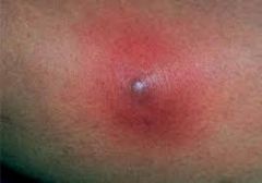 a "boil"
deep foliculitis with infection & pus
commonly S. aureus
Treat: warm compress -> lance -> Abx