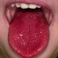 "Strawberry Tongue"