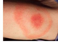 Borrelia Burgdorferi
Ixodes scapularis
Early erythema migrans (pic) 
Mid: CN 7 - Facial palsy's; meningitis; encephalitis (mood)
Late: cognitive, mental dx, gait abn, numbness, tingling,
Treat: Amoxicillin or doxycycline (avoid sun/inactivates est...