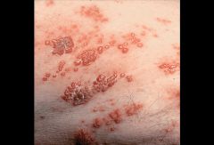Chicken pox
Herpes Zoster (shingles)
Treat: acyclovir
Pregabalin (newer gabapentin/neurontin) to treat post-shingles' neuralgia