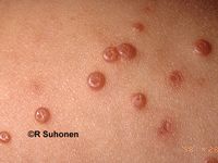 Dome shaped w/ white spot in middle
Usually children
pox from direct/sexual contact
Treat: often go away with age or removal (salicylic acid, cryo, electrosurg, needle curettage)