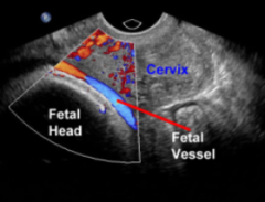 umbilical cord vessels precede presenting fetal part and overlie cervix