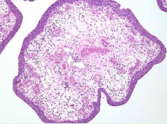 nodule found in bladder