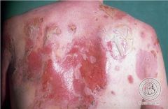 Usually child
Autoantibodies against Desmosomes  - Nikolsky + - slough/rupture skin at basal membrane with rub - Dx: immunoflourescent skin