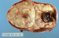 taken from kidney of a 4-year-old
