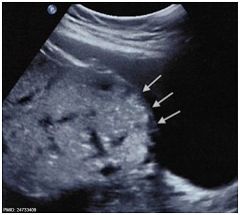 placental vessels extending into maternal urinary bladder