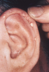 A male with an acute monoarthritis, presents with the above features on general examination. What are these lesions called ?