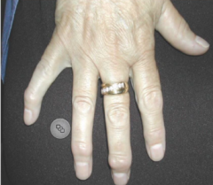 This is the hand of a 58 year old lady with painful hands and early morning stiffness lasting 20 minutes. What special investigation will confirm your diagnosis ?