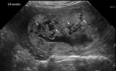 abnormal adherence of all/part of placenta with ABSENCE of all/part of decidua basalis

- chorionic villi grow into myometrium