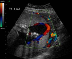 *discrete lobe w/ placental appearance
- Doppler to see vessels connection lobe to placenta