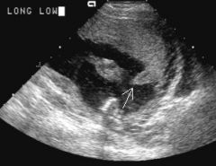 placental margin appears...
- folded
- thickened
- elevated
- fibrin & hemorrhage underneath