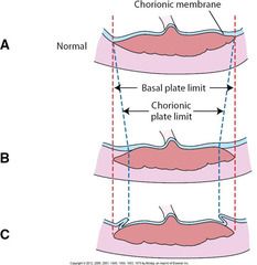attachment of placental membranes towards center (fetal portion) rather than to the placental margin

**RESULTS in villi that are NOT covered by chorionic plate