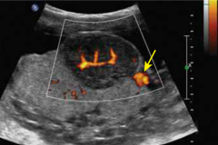 - hypoechoic, well-circumscribed placental mass
- possib near cord insertion site