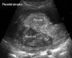 - elevation of placenta from uterine wall
- retroplacental anechoic / complex mass without blood flow
- may appear normal or thickened