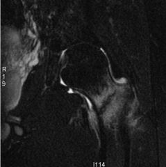 A 20-year-old male marathoner has had left sided groin pain for the past 4 weeks. He has continued to maintain his routine running regimen despite the discomfort. Radiograph, bone scan, and MR images are shown in Figures A-D. What is the most app...